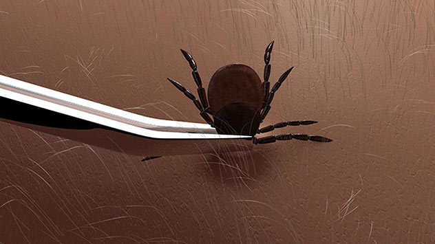 Zecke mit Pinzette entfernen