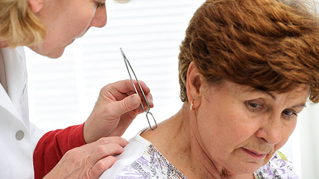 Zecke von Ärztin entfernt