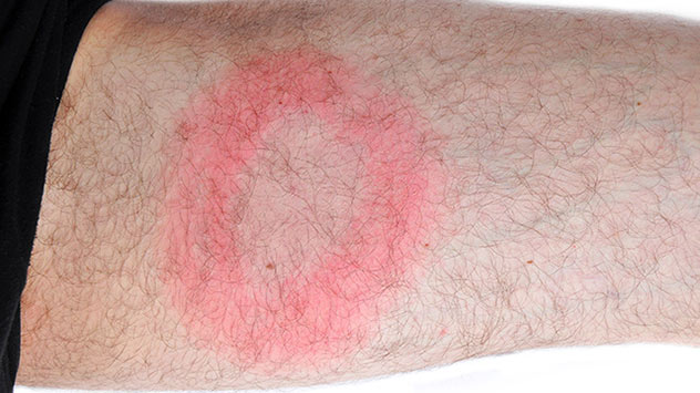 Wanderröte auf Wade