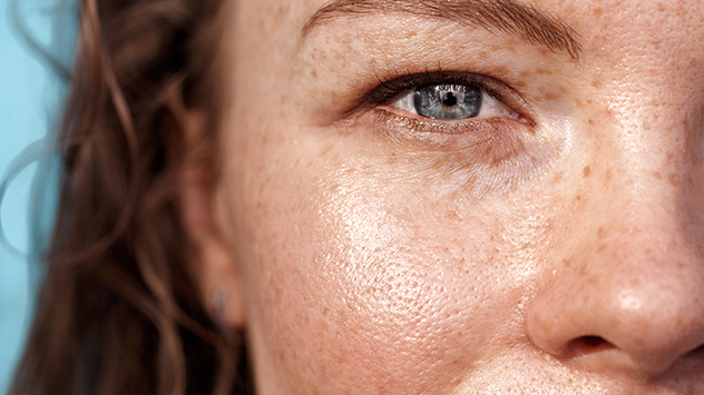 freckles
